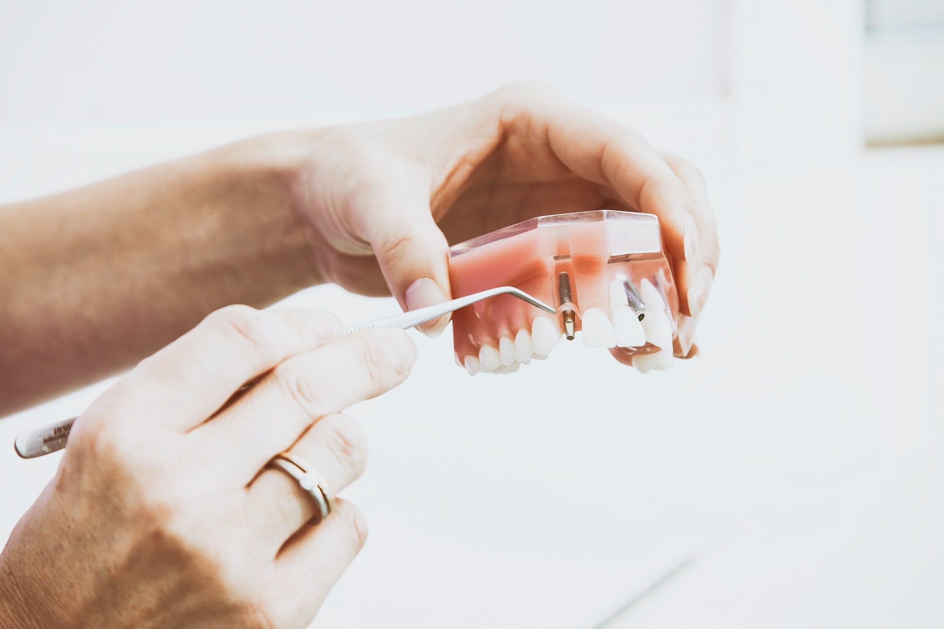 why are dental implants so expensive - person holding model teeth with implants