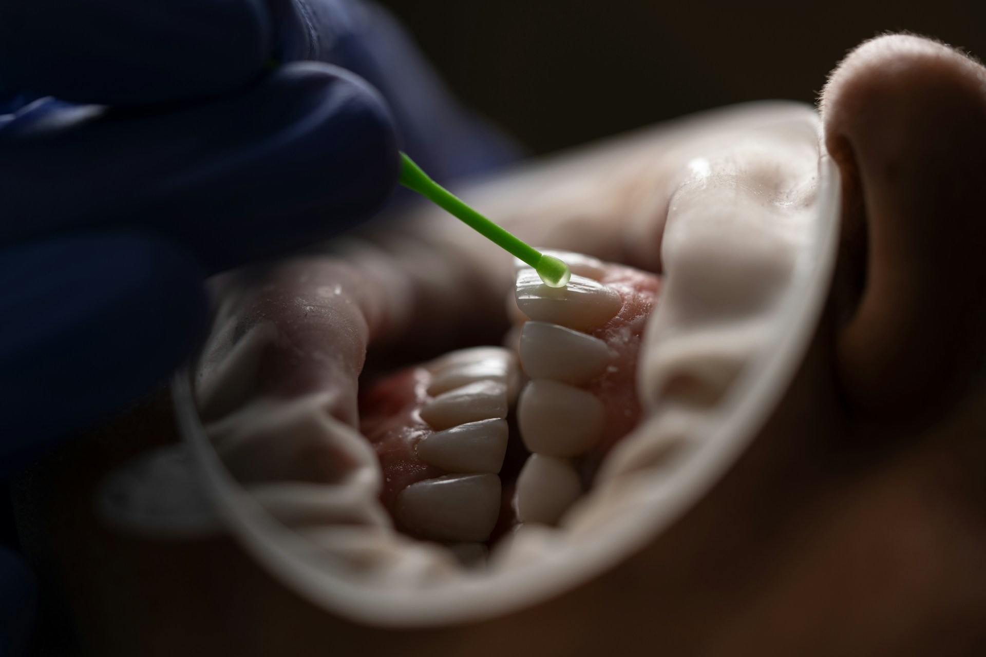 what is tooth bonding, how long does tooth bonding last, tooth bonding procedure